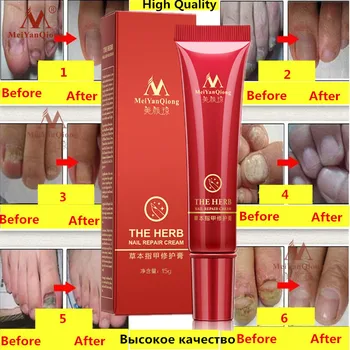 MeiYanQiong a base de Hierbas de Uñas Tratamiento de la Onicomicosis Paroniquia Contra la Infección Micótica de la Uña de Dedo del pie Uña Hongo Tratamiento de 15ml