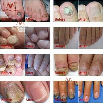 MeiYanQiong a base de Hierbas de Uñas Tratamiento de la Onicomicosis Paroniquia Contra la Infección Micótica de la Uña de Dedo del pie Uña Hongo Tratamiento de 15ml