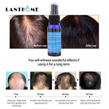 Lanthome Contra la Pérdida del Cabello Producto Tónico en Spray para el Crecimiento del Cabello Alopecia Contra la Calvicie Tratamiento Sunburst de Rebrote de Cabello Líquido Yuda