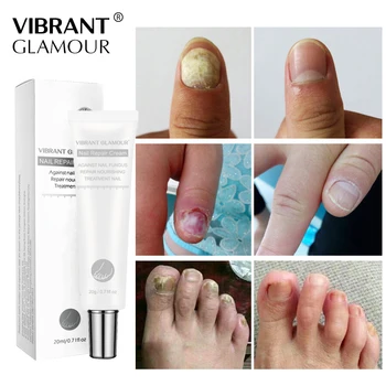 VIBRANTE GLAMOUR Cuidado de las Uñas, Set de Reparación de Uñas Crema Anti Hongos en Uñas de pies de Reparación de Suero de Protección de Iluminar la Nutrición