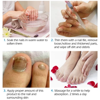 VIBRANTE GLAMOUR Cuidado de las Uñas, Uñas de Reparación de Crema de Hongos en las Uñas Tratamiento de la Onicomicosis de Eliminación de Anti Hongo del Uña del Dedo del pie de Reparación de Crema de 20ML